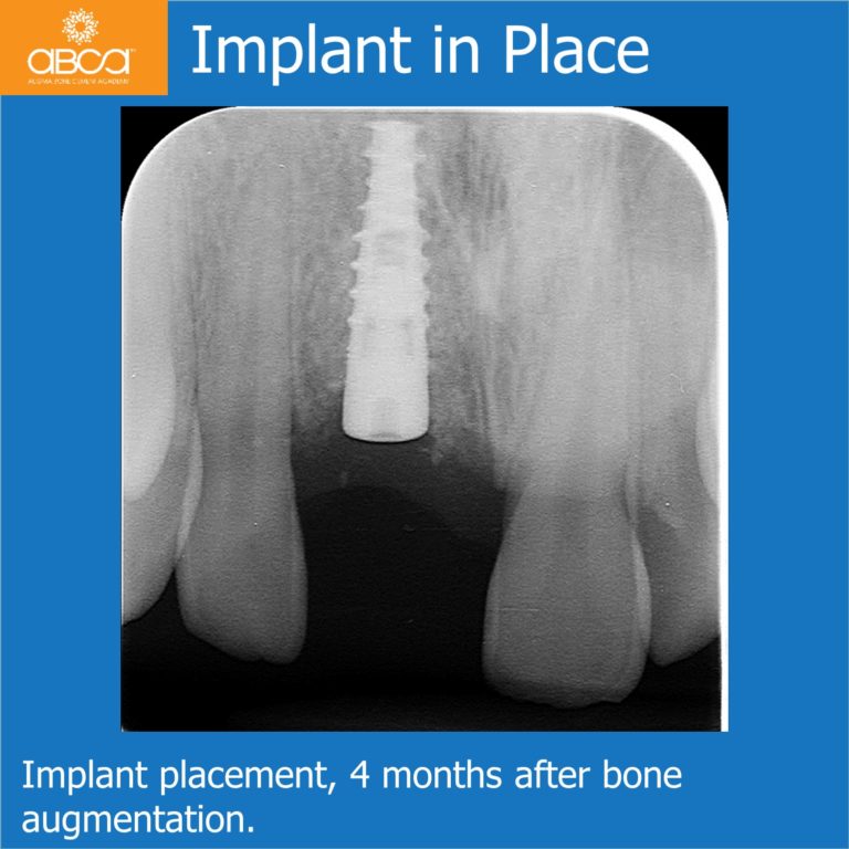 Implant and Augma in the Aesthetic Zone